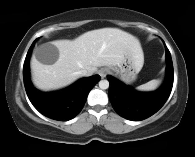 liver cyst ct