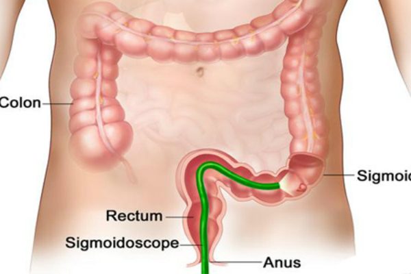 Anal Fistula FiLaC